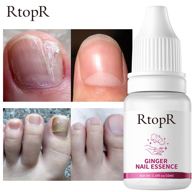RtopR Ginger Antibacterial Nail Treatment Serum Essential Onychomycosis