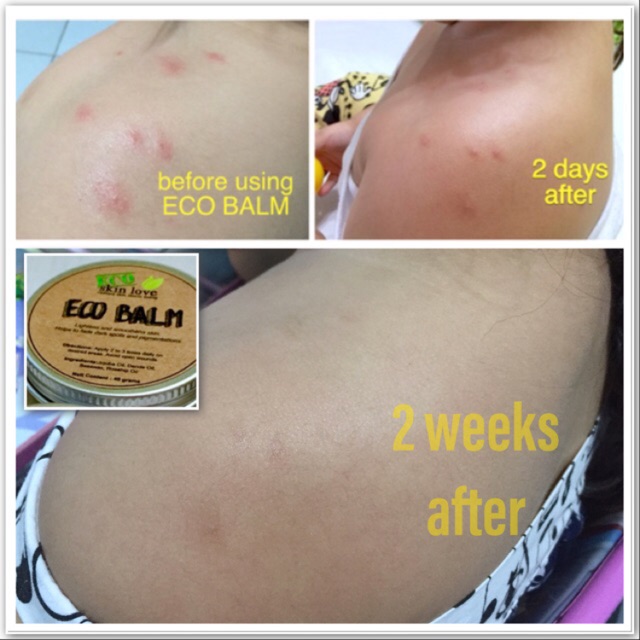 insect bites cream for baby philippines