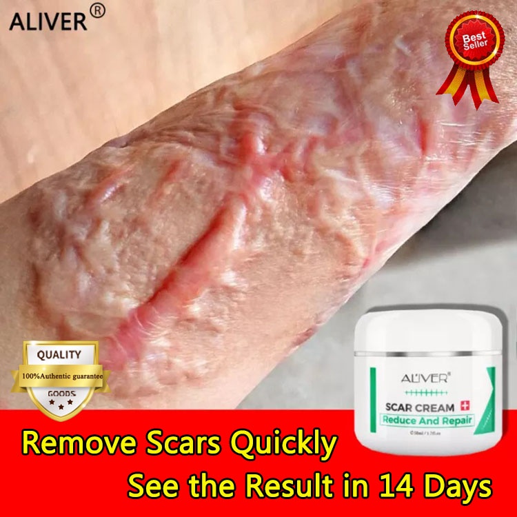 aliver-scar-removal-cream-50ml-acne-spots-stretchmarks-burn-scar