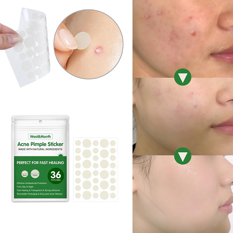 Acne Pimple Patch Hydrocolloid Acne Spot Treatment  Invisible Pimple Patch for Healing Acne Dot