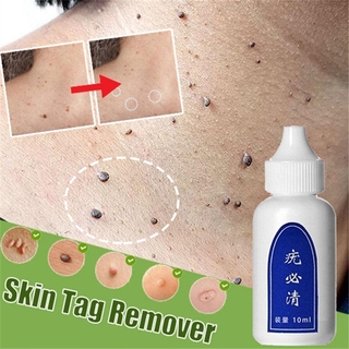 Ultra Strength Natural Health Mole Nevus Wart Skin Foot Tag Warts Tag Removal Corn Skin O3X5 #1