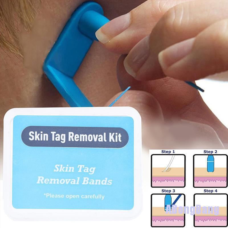 【abongbang】☆30pcs Skin Tag Removal Rubber Bands Micro Band Non Toxic Face Care Mole Wart