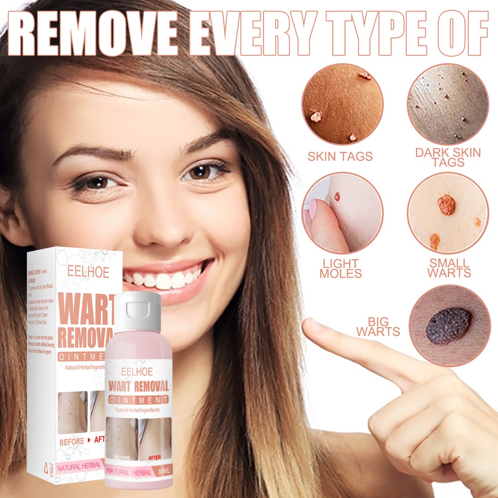 Warts Remover Ointment Cream Wart Tag Corn Antibacterial Treatment