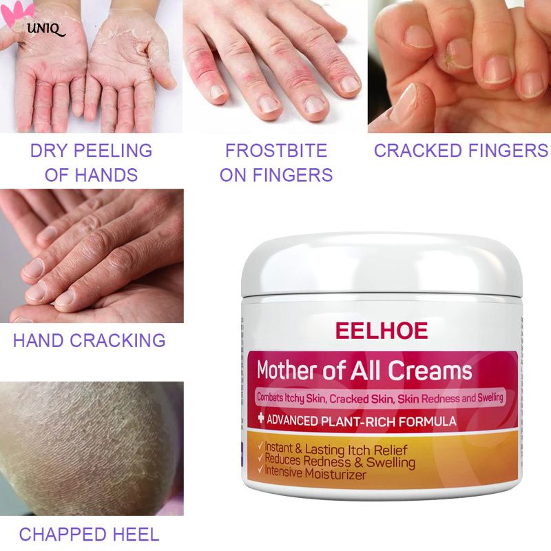 READY EELHOE skincare cream Eczema Cream AntiItch Cream Skin Topical