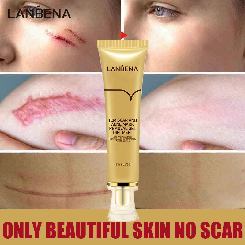 Tcm Acne Scar Removal Cream Price In Sri Lanka