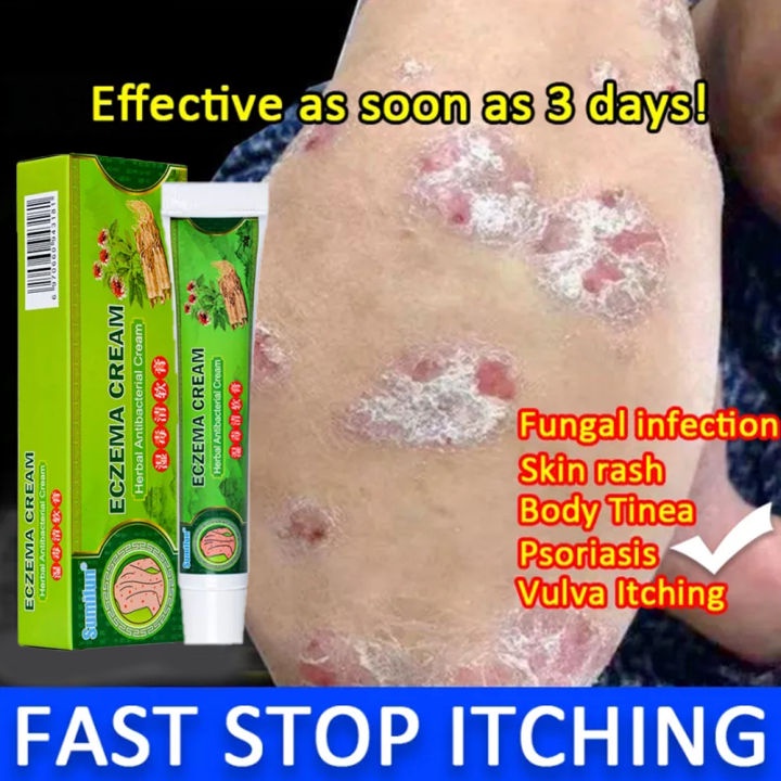(Hot)Eczema Treatment Cream gamot sa kati kati sa balat buni Psoriasis