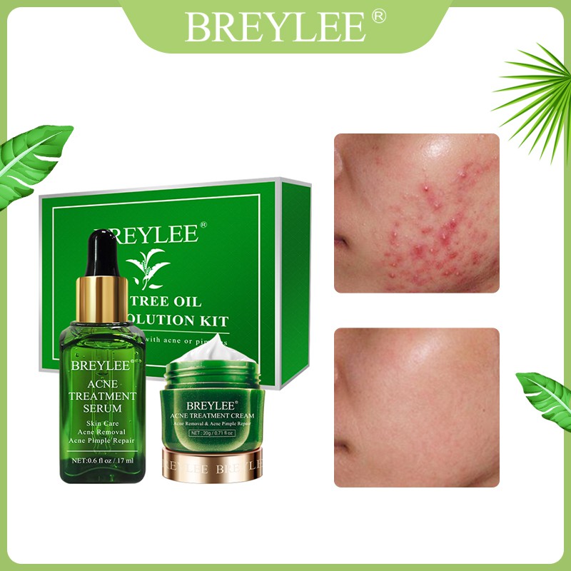 Breylee Acne Treatment Serum Cream Spots Pimple Removal Essence Anti Acne Scar Skin Care17ml 20g Shopee Philippines