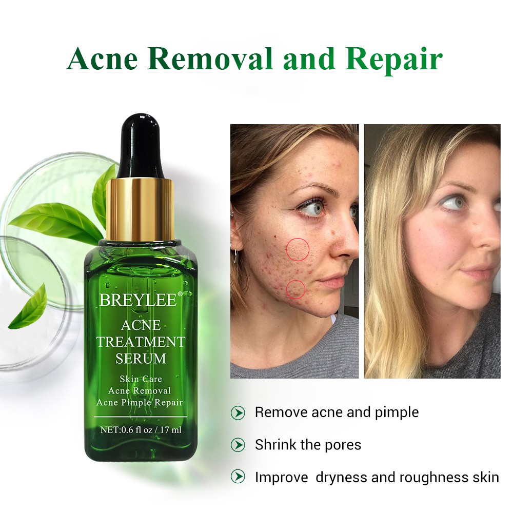 Breylee Acne Treatment Serum Cream Kit Spots Pimple Removal Essence Anti Acne Scar17ml 20g Shopee Philippines