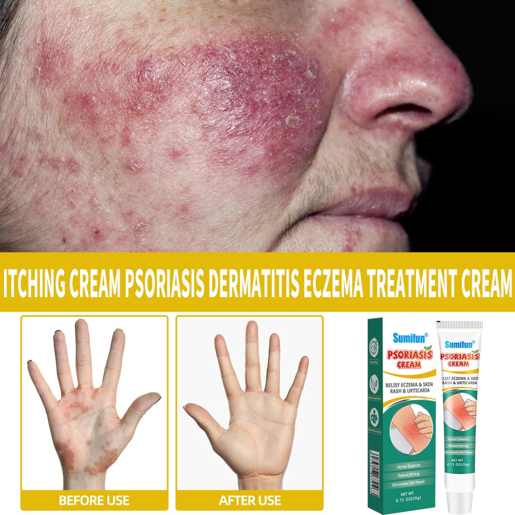 Itching cream Psoriasis Dermatitis Eczema Psoriasis Ointment ...