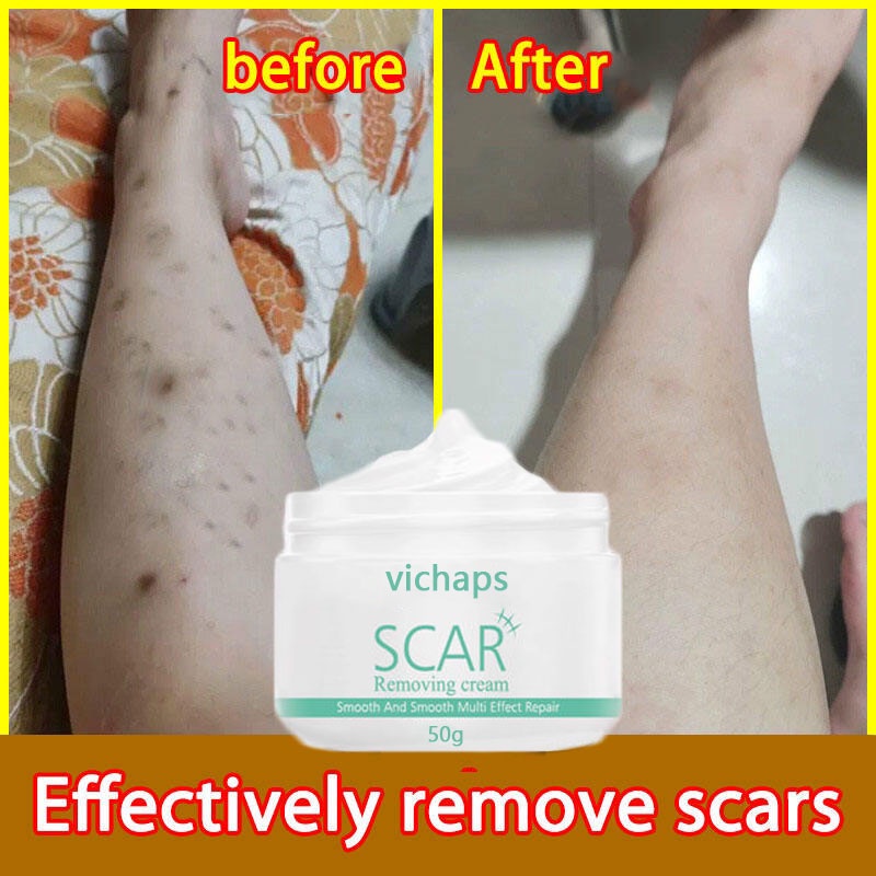 Scar Remover for Old Scar on Leg Stretch Mark Remover Acne Scar Remover Cream Shopee Philippines