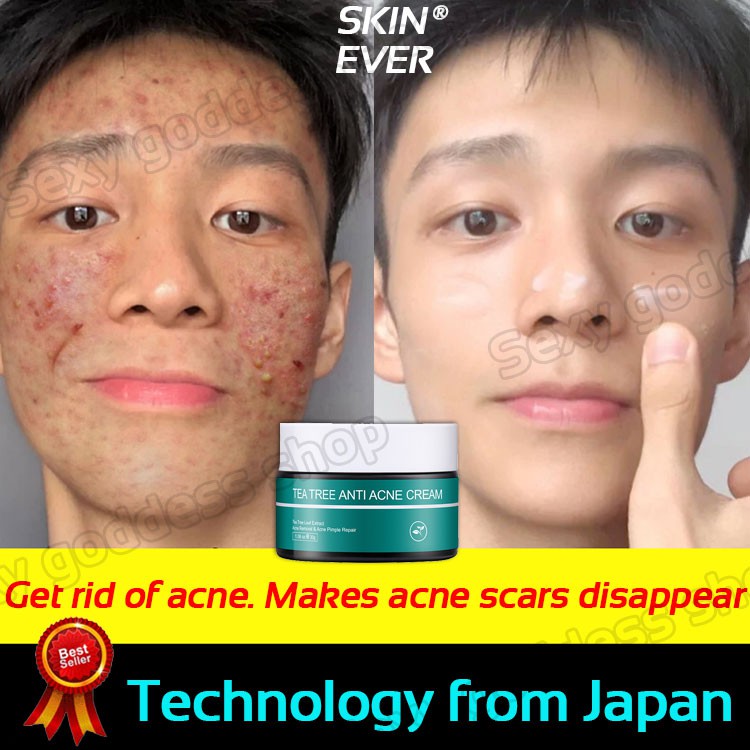 acne scar treatment products philippines