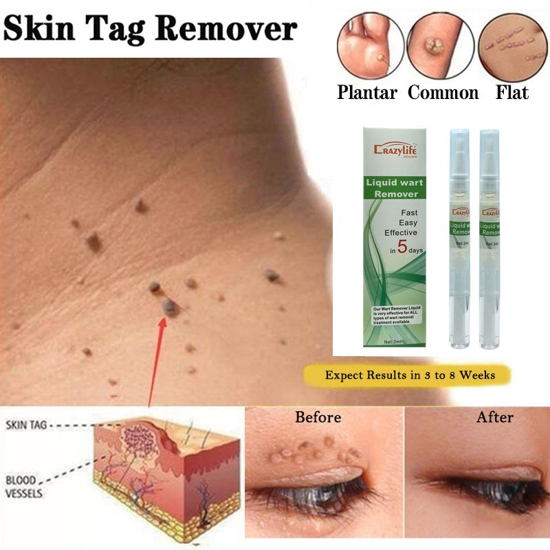 Skin Tag Remover Pen Natural Health Wart Skin Tag Foot Corn Warts