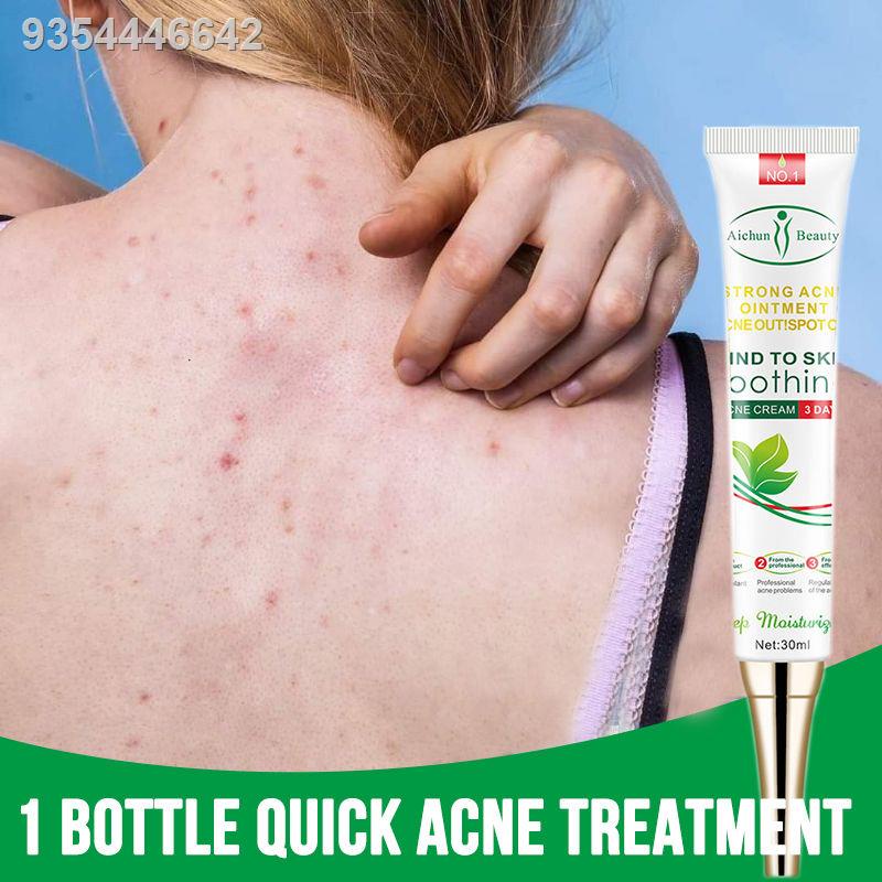 (hot sale)Best Selling pimple eraser Acne cream pimple remover pimple