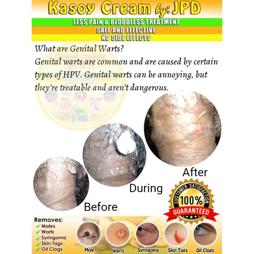 Cream for hpv warts