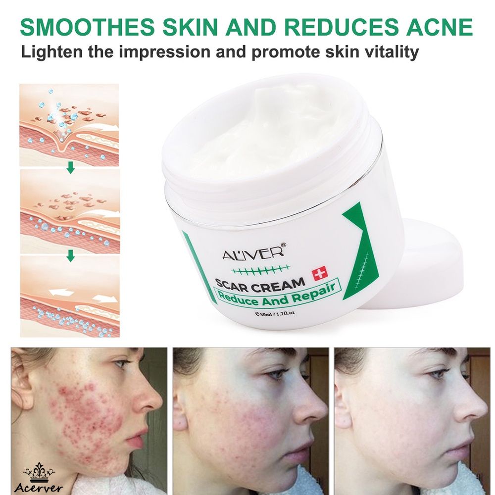 Aliver Scar Removal Cream 50ml For Old Scars Scar Gel Acne Scars 