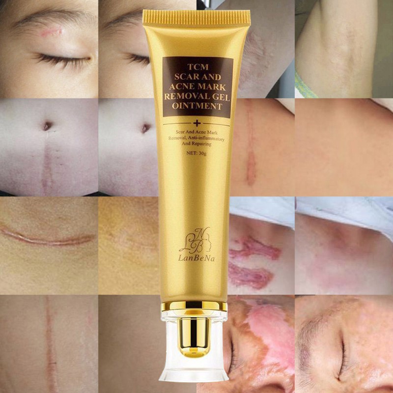 tcm scar and acne mark removal gel ointment price
