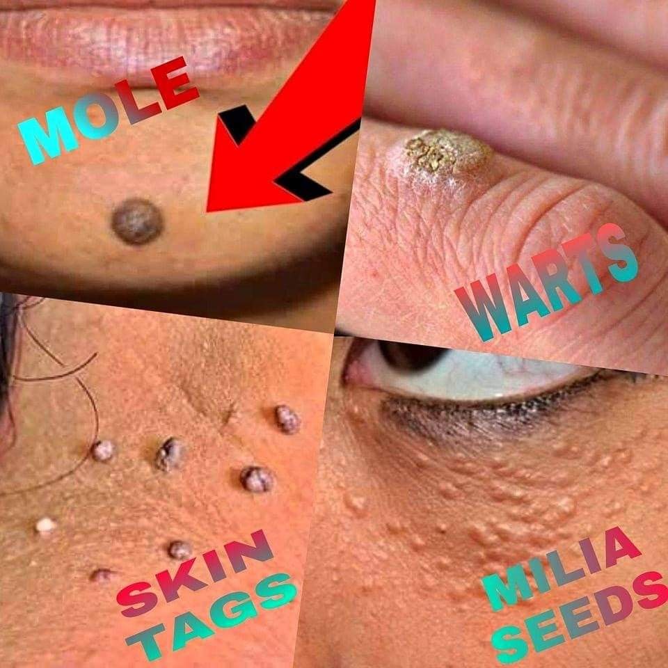 WARTS SOAP REMOVAL[ SKINTAGS/KELOIDS/MILLIA/MOLE/SYRINGOMA Shopee Philippines