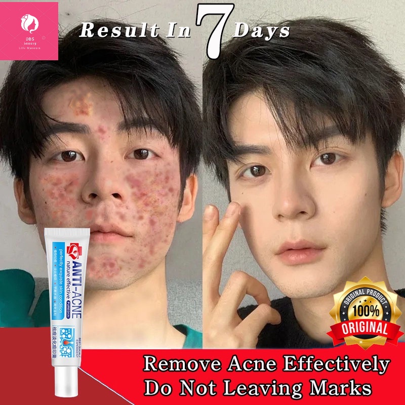 30g AntiAcne Cream Acne Treatment Gel Pimple Scars Remover Skin Care