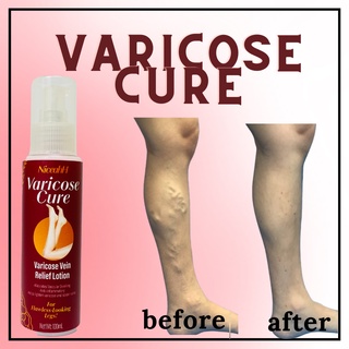 100% Original and Effective Varicose Cure| Varicose Vein Treatment Cream