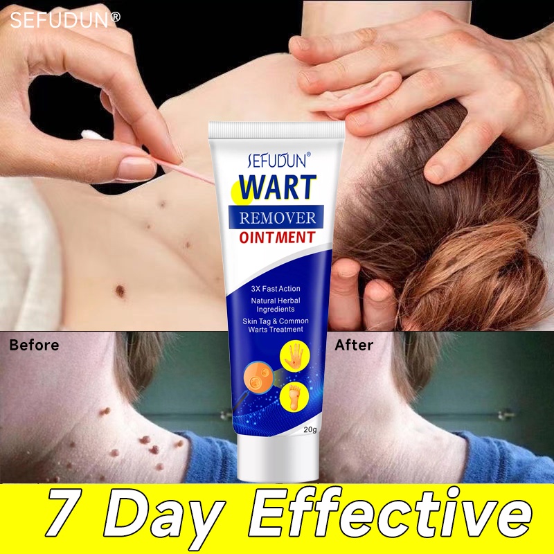 20g Sefudun Warts Remover Original Cream Warts Magic Remover Wart Treatment Warts Removal Skin