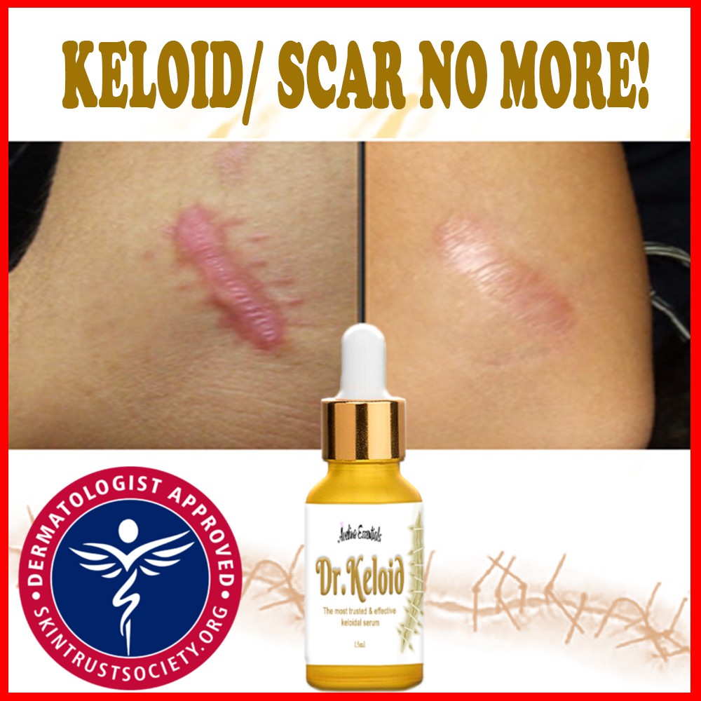 ⚡keloid Remover Serum⚡ By Doctor Keloid Treats Acne Marks Stretch 3967