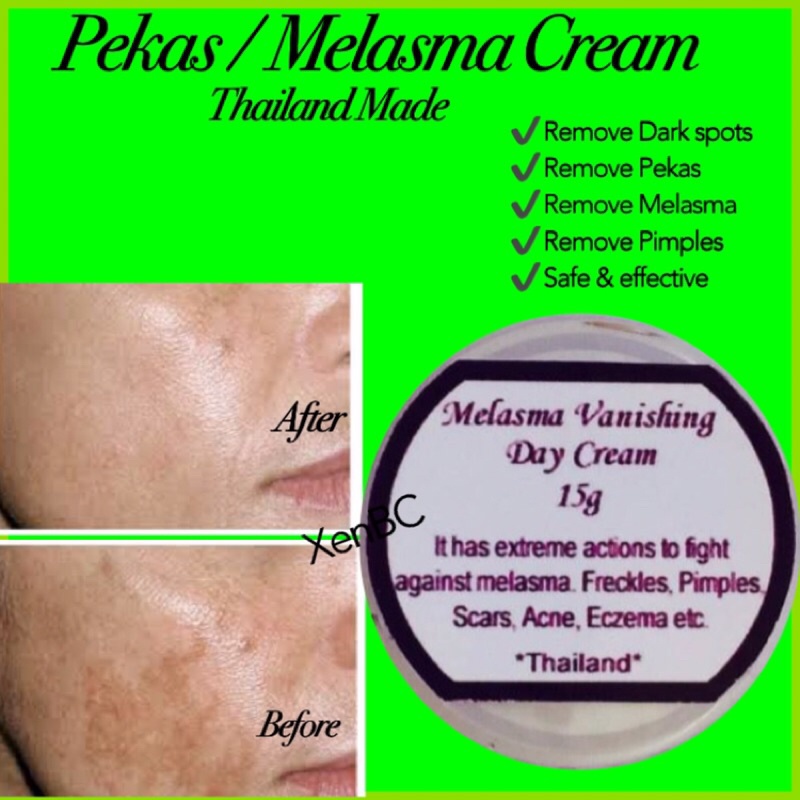 Pekas Eraser Melasma eraser cream Shopee Philippines