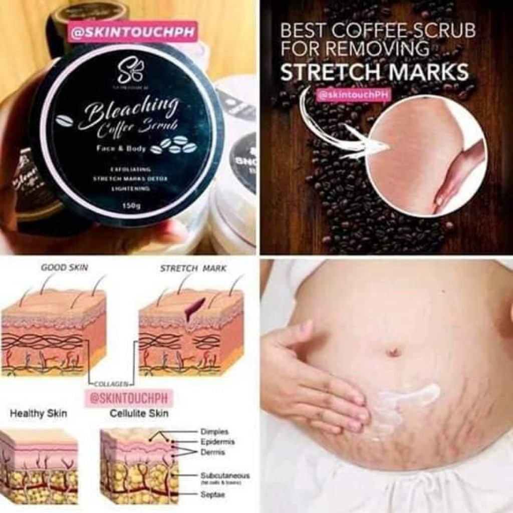 bleaching stretch marks