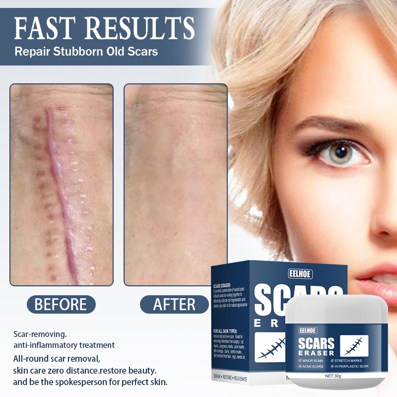 Original Scar Remover Cream Old Scar on Leg Scars Remover Burn Scar