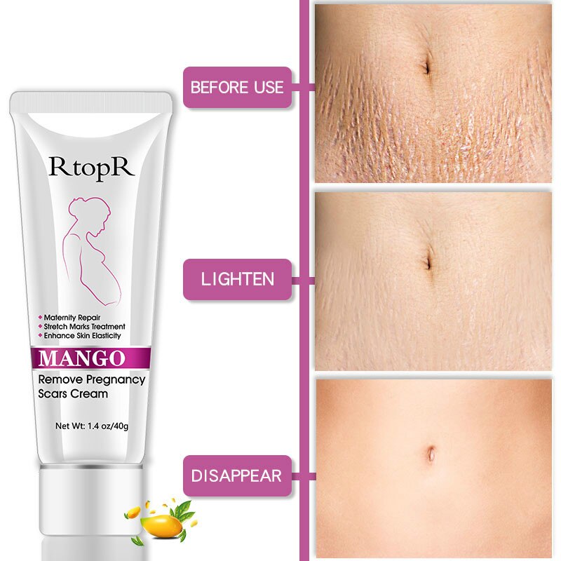 stretch marks on breast cream