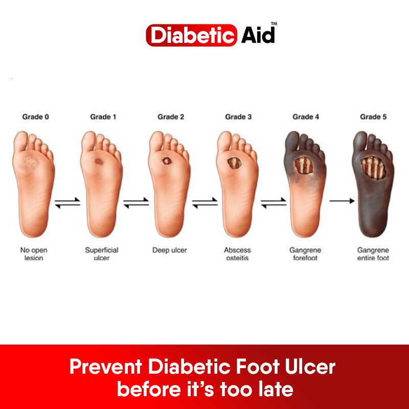 Diabetic Aid Foot Cream Shopee Philippines