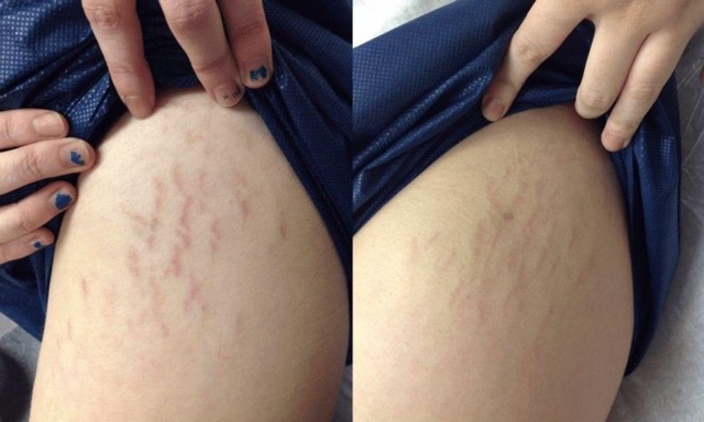 Hermes Beauty Strecth Mark Remover Shopee Philippines