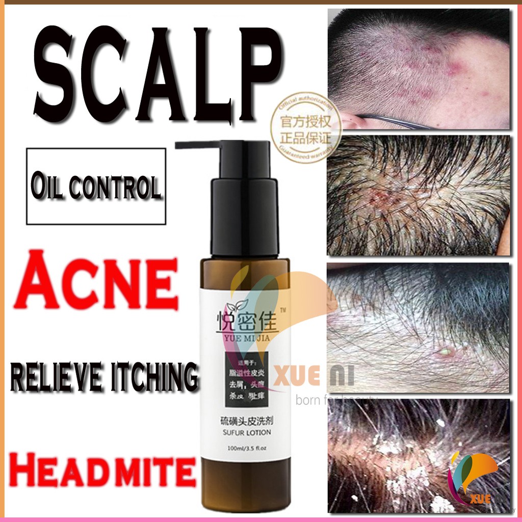 Scalp folliculitis red and swollen acne antidandruff and antiitchy