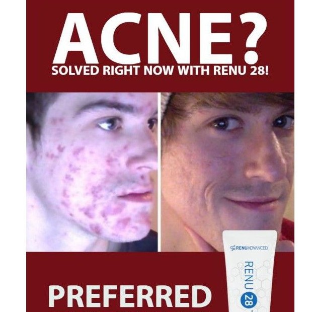 renu 28 acne