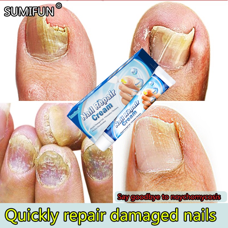 Nail fungus repair treatment paste stimulate the healthy growth of the nails mild and non