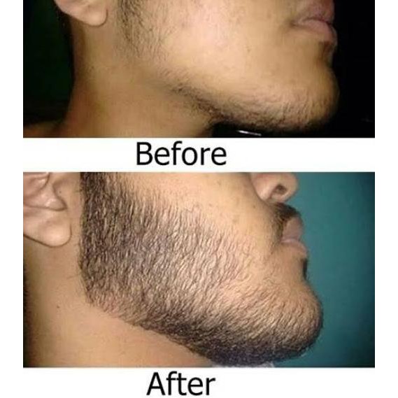 Рост волос на лице у мужчин. Миноксидил 3%. Миноксидил 3 в 1. Миноксидил 5 для бороды.