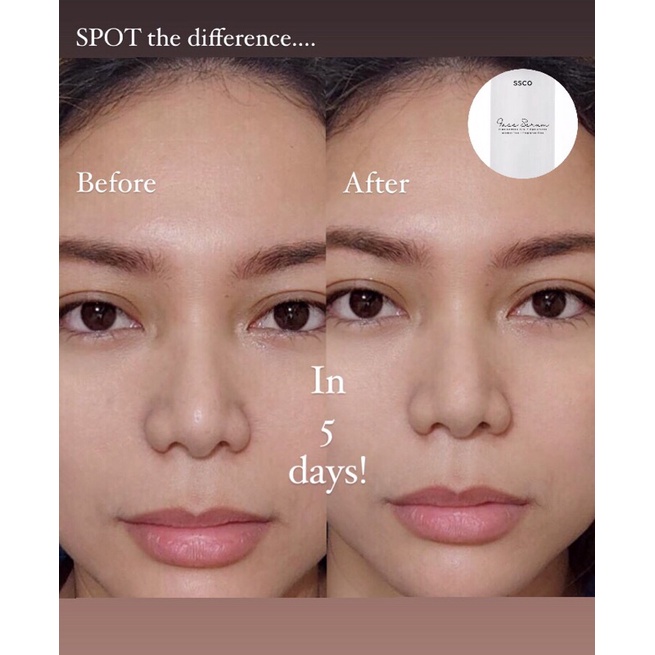 DARK SPOT REMOVER Niacinamide 10 + Hyaluronic Face Serum (safe for