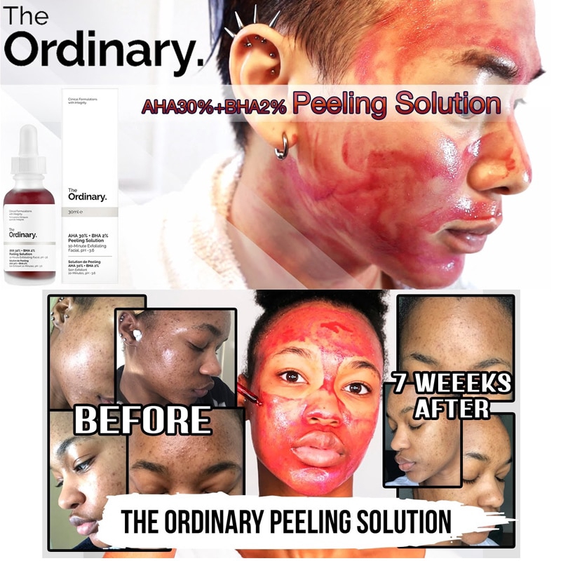 ordinary acne peeling solution
