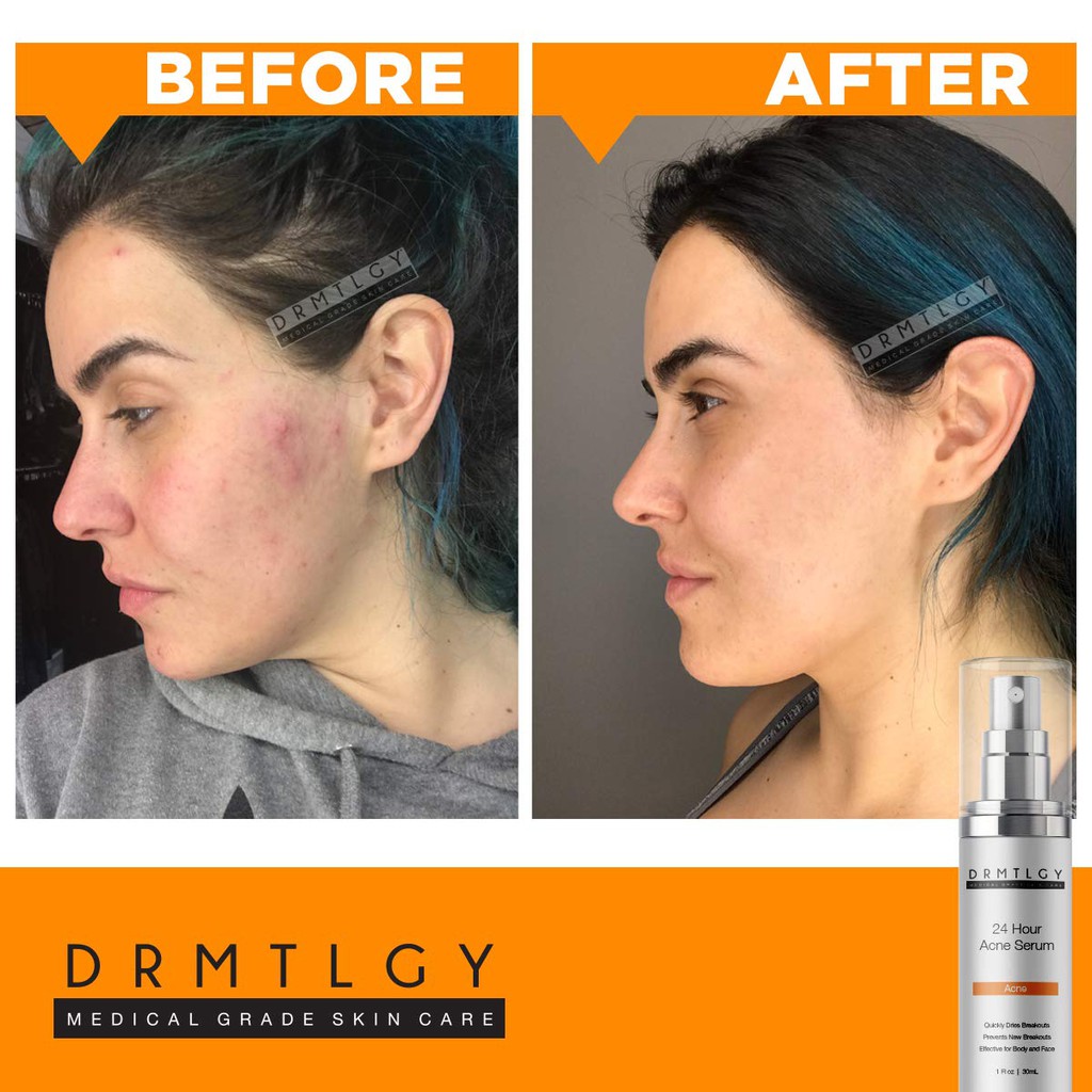 drmtlgy acne
