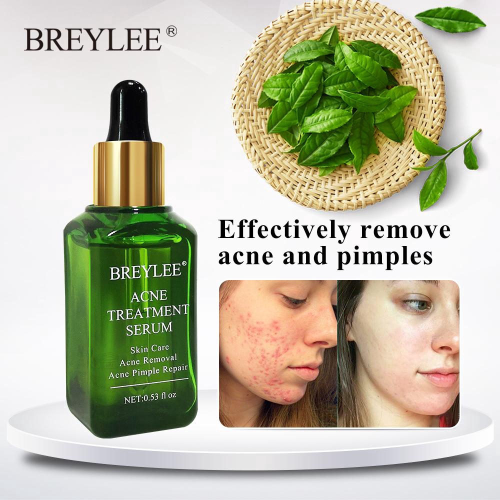 best essence for acne
