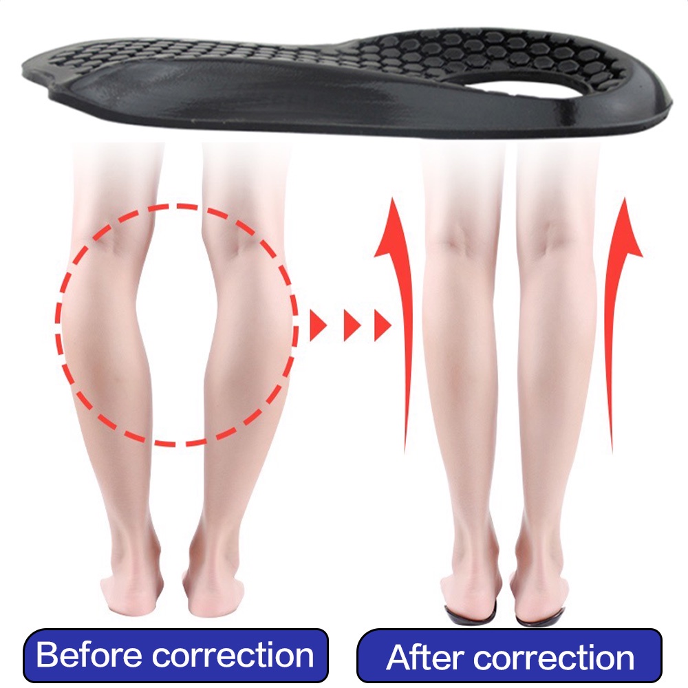 Pedimend™ Gel Flat Foot & O/X Leg Correction Insoles – Arch Support Orthopedic Wedge Pads For Men & Women