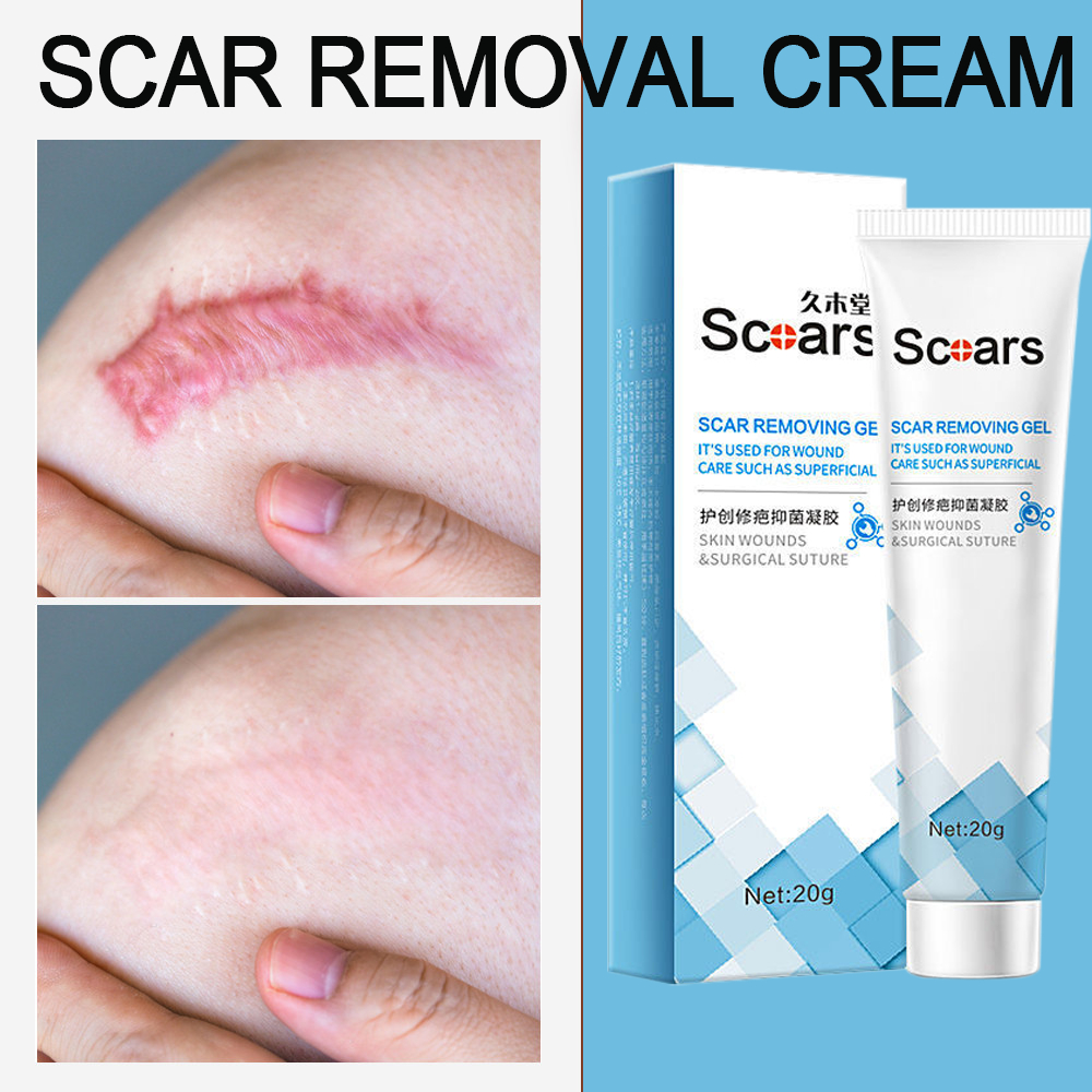 Scar Removal Cream Peklat Remover Scar Gel Acne Treatment Scar Remover ...