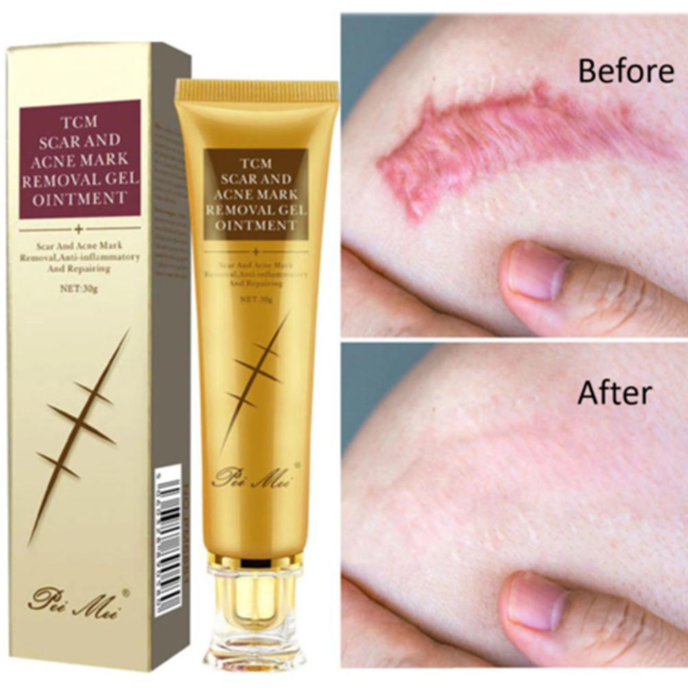 30g Light Scar Cream Fades Pregnancy Cesarean Section Bump No Gel Gel Scars Trace H5K0 Shopee