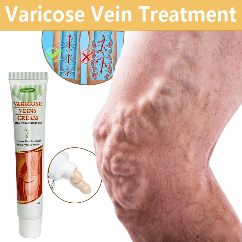 Varicose veins Vasculitis Treatment Cream relieve swelling pain