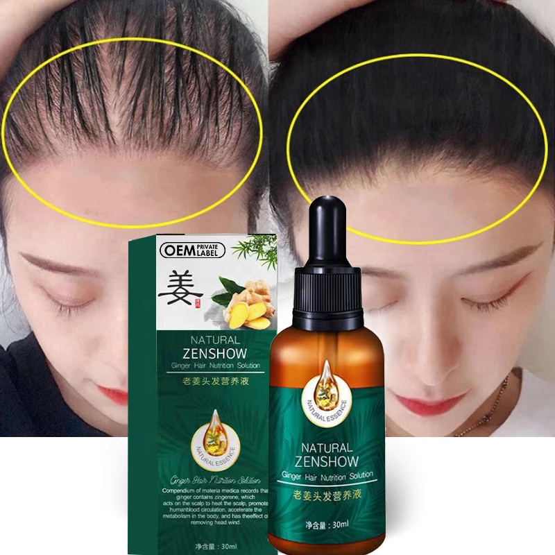 YANJIAYI 30ML Minoxidil Fast Hair Growth Serum Ginger Hair Treatment ...