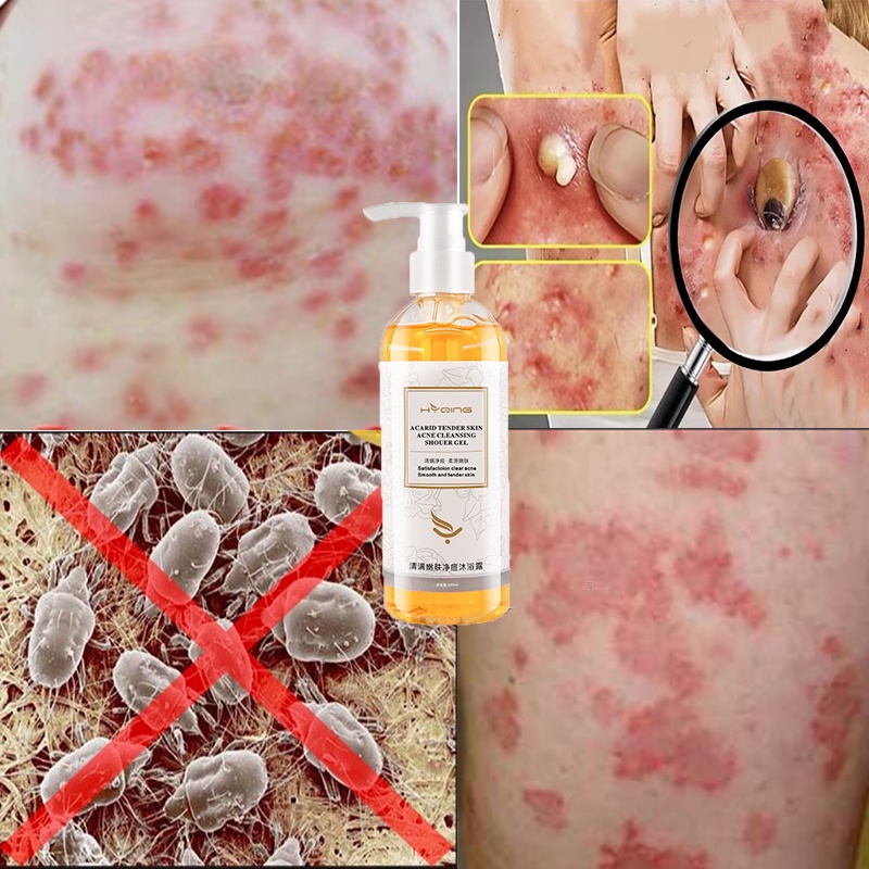 anti mite shower gel