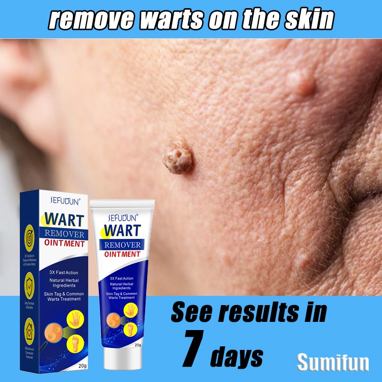 Warts Remover Cream Wart Removal Cream Mole Remove Warts Flat Warts