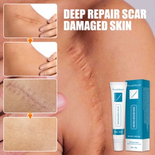 West&Month Acne Treatment  Dark Spot Remover Repair Strech Marks 20g Acne Scar Pimples Marks Acne Sc #6