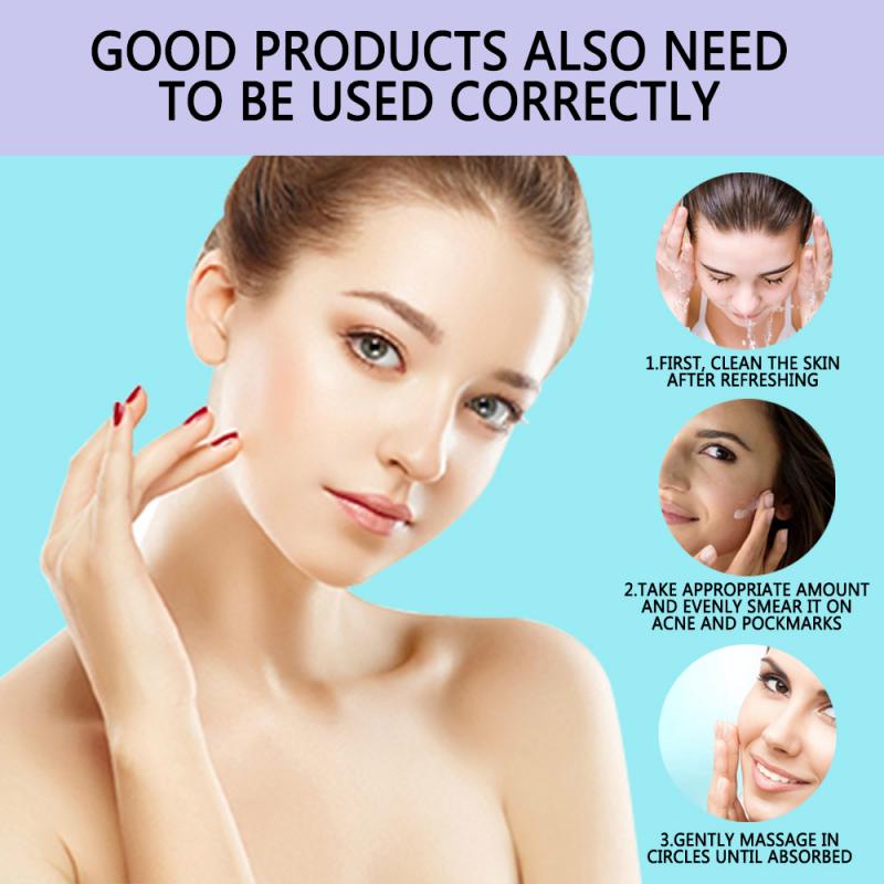 ▲⊙1 Pcs NEW Blemish Cream Freckles Acne Pimple Spots Removal Treatment Pimple Ointment Scar Mark  A