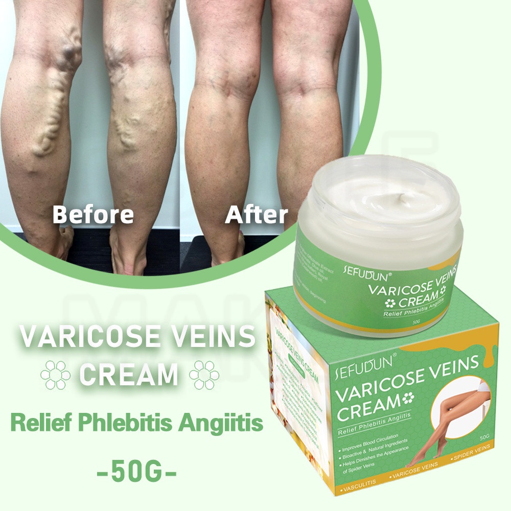 SEFUDUN Varicose Vein Cream Varicose Vein Treatment Cream Effective ...