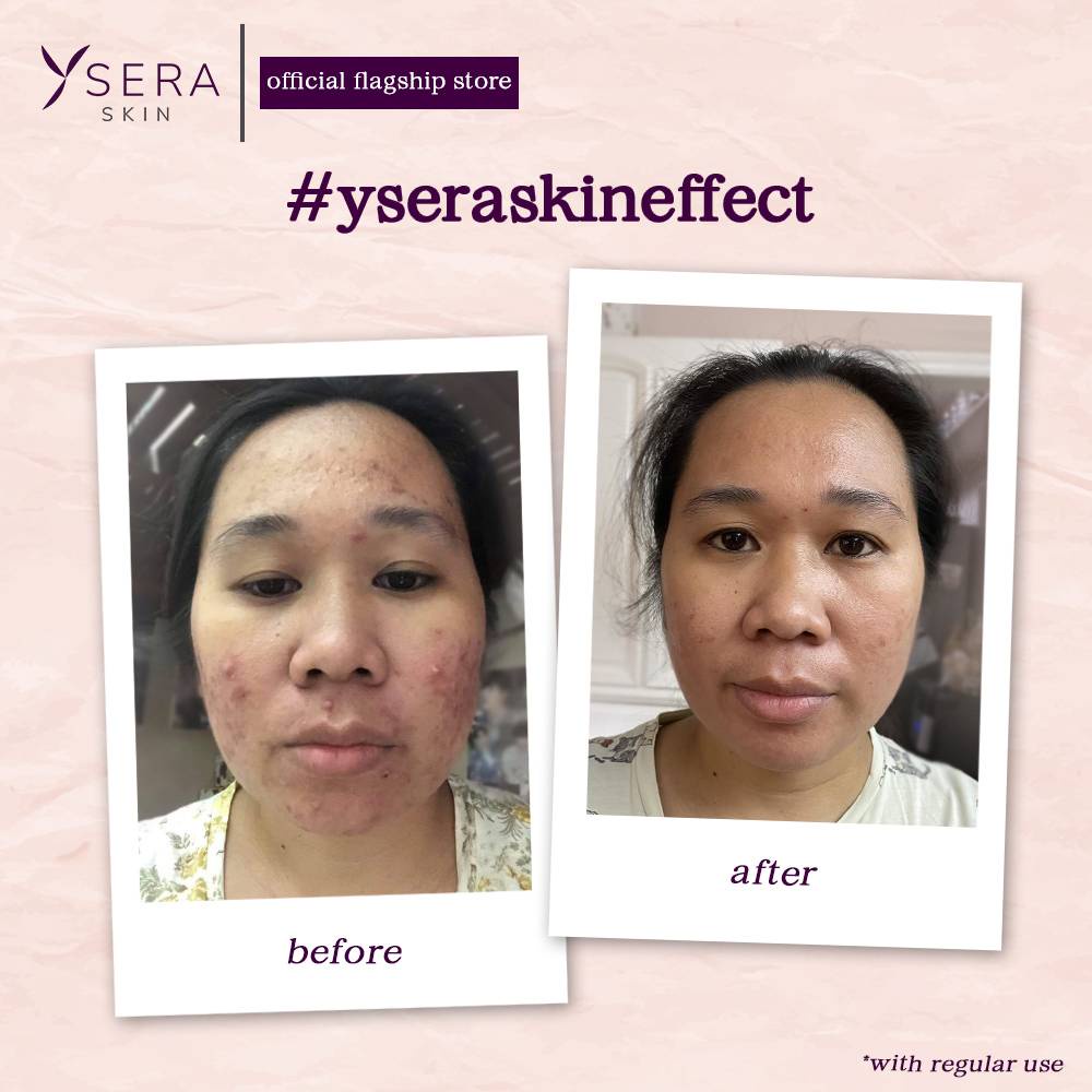 betadine skin cleanser YSERA SKIN Azelaic Foam Wash All-In-One Cleanser